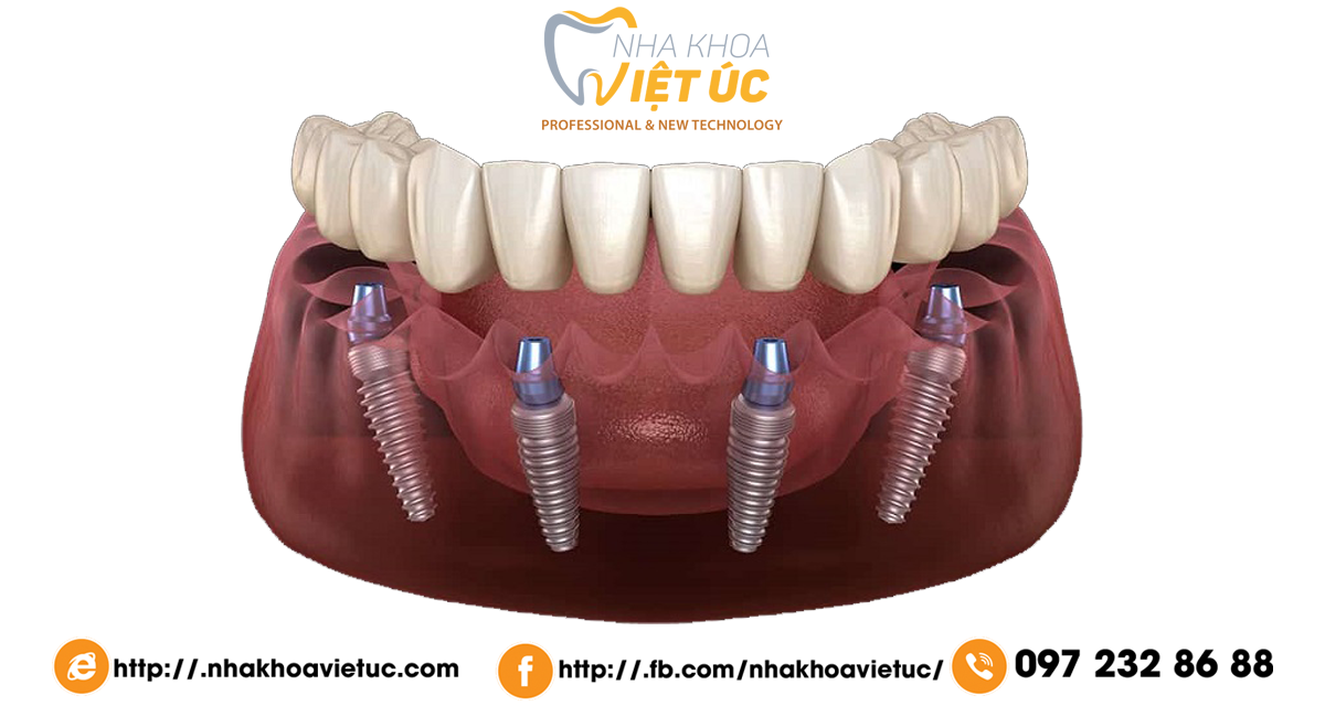 implant cải thiện tình trạng mất răng lâu năm