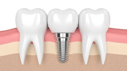 NHỮNG LỢI ÍCH KHI TRỒNG RĂNG IMPLANT MÀ CÁC BẠN NÊN BIẾT