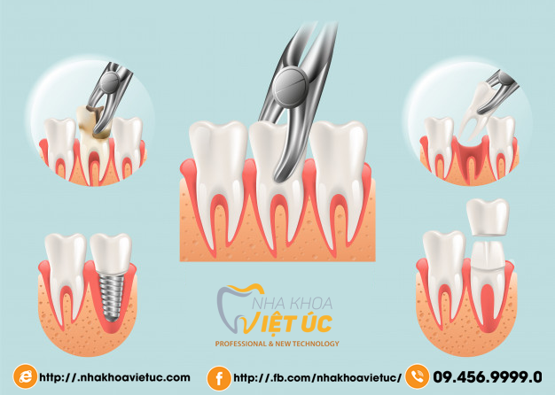 realistic-illustration-tooth-extraction-vector-3d_81522-3824