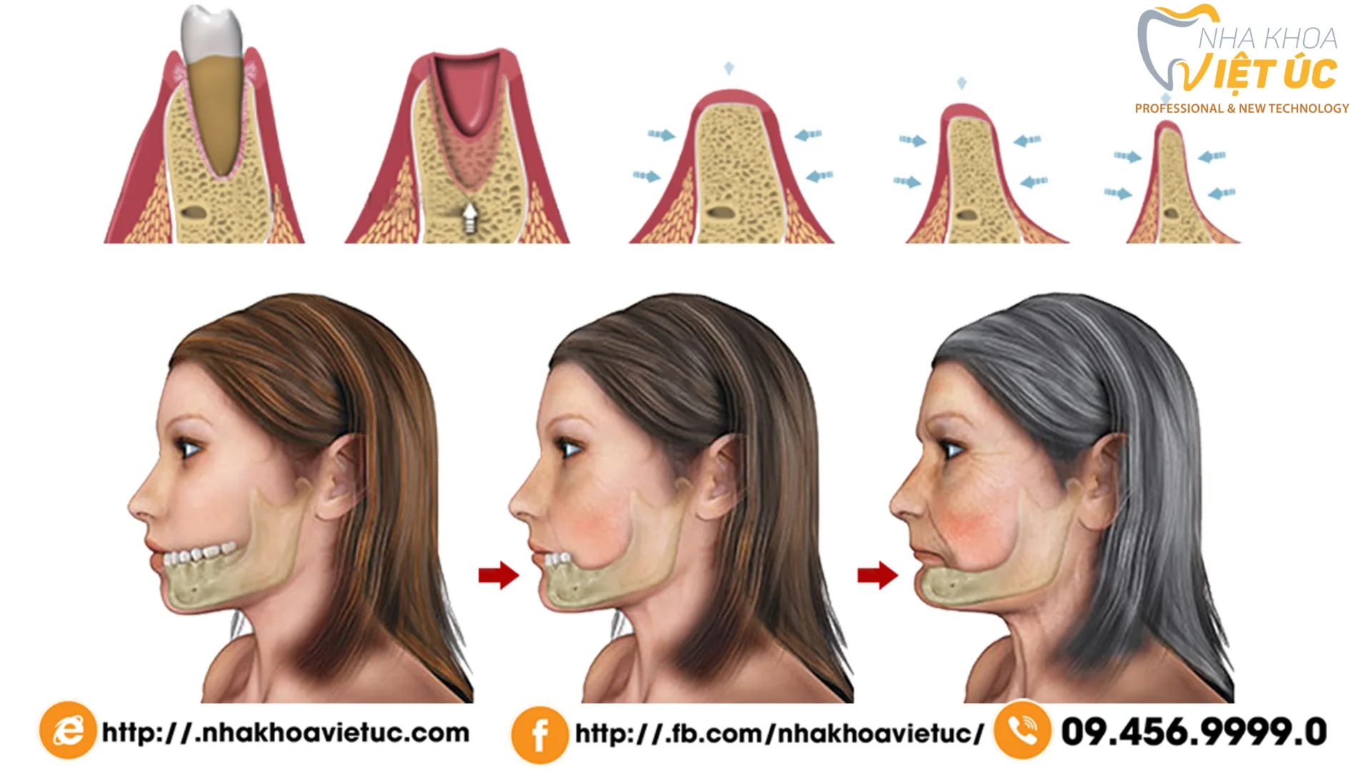 tiêu xương hàm do mất răng quá lâu