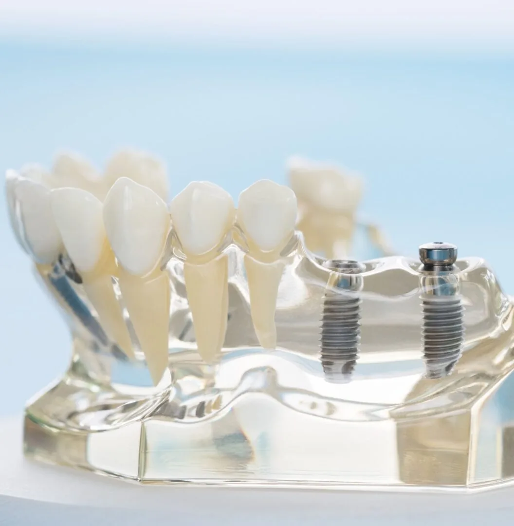 NHỮNG LỢI ÍCH KHI TRỒNG RĂNG IMPLANT MÀ CÁC BẠN NÊN BIẾT