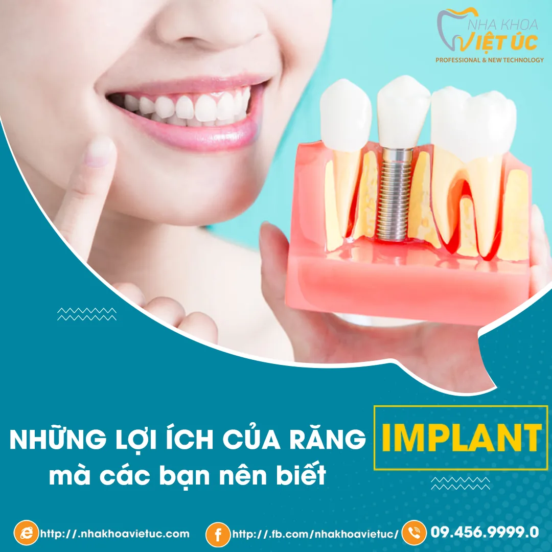 Trồng răng Implant là phương pháp phục hình răng đã mất hiện đại và tiên tiến nhất hiện nay. Cùng với những ưu điểm vượt trội hoàn toàn so với các phương pháp trồng răng giả truyền thống, trồng răng Implant đã trở thành sự lựa chọn hàng đầu của nhiều người mất răng tại Việt Nam và trên toàn thế giới. Dưới đây là những lợi ích khi trồng răng Implant mà các bạn nên biết để có sự lựa chọn phương pháp trồng răng hợp lý.