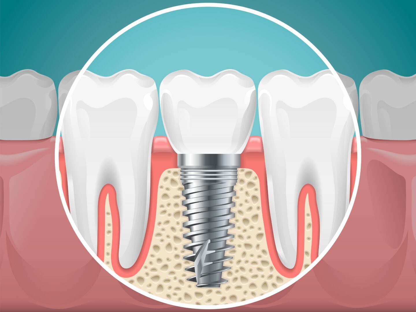 Răng Implant