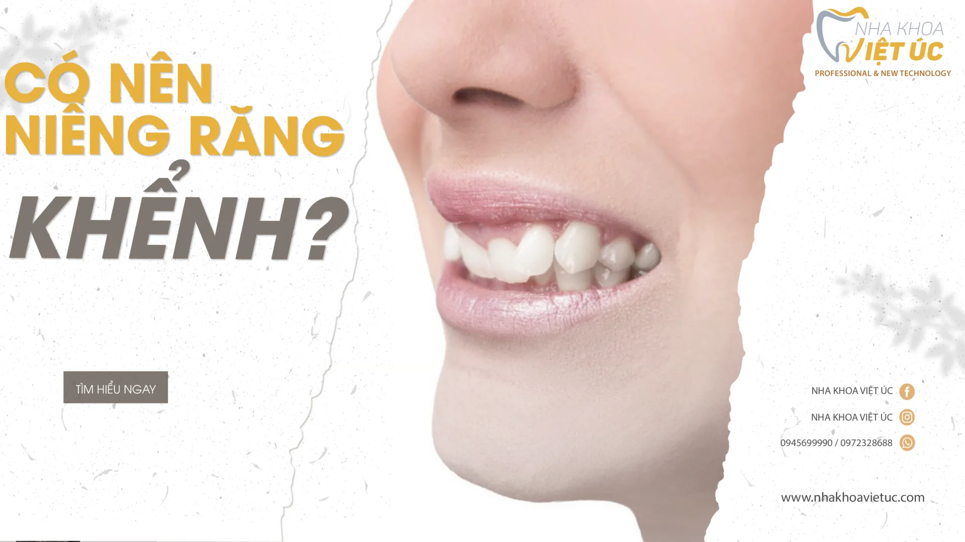 [NHA KHOA VIỆT ÚC] RĂNG KHỂNH CÓ NÊN NIỀNG