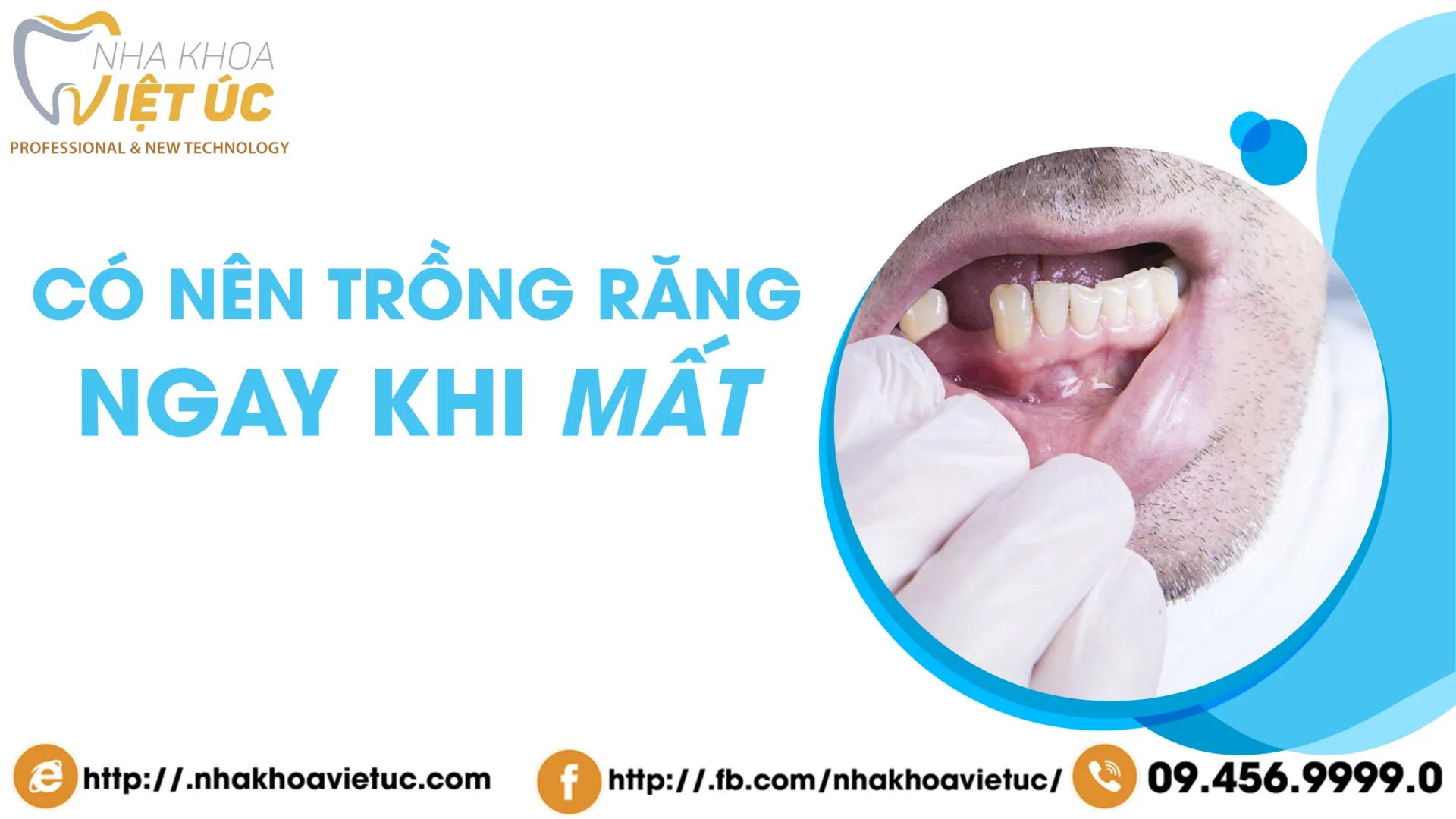 có nên trồng răng ngay khi mất