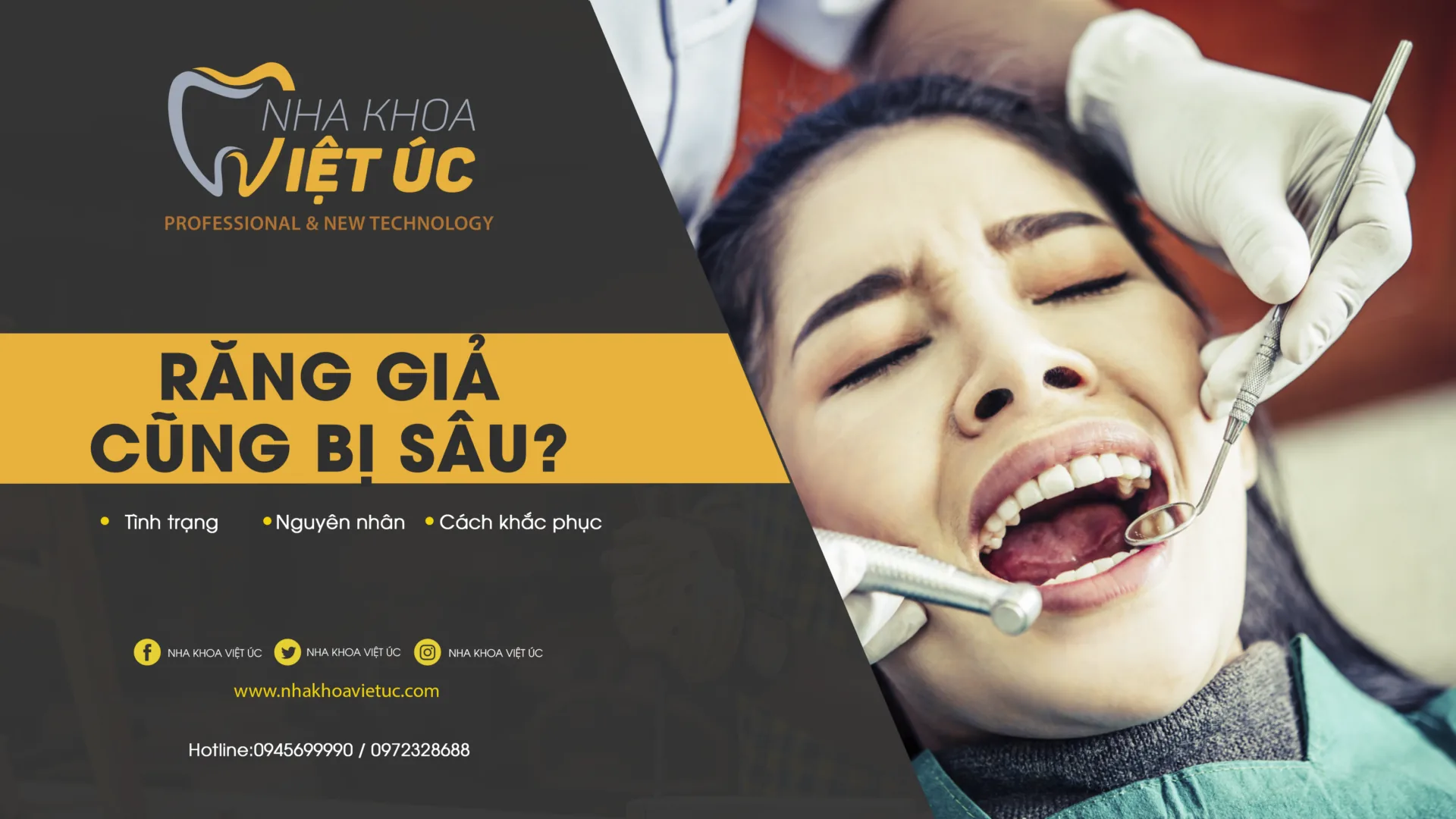 [nha khoa việt úc] răng giả cũng bị sâu