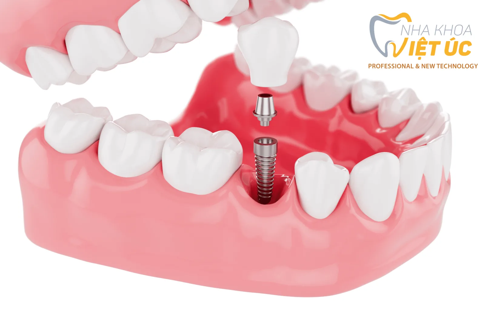 TRỒNG RĂNG IMPLANT ĐỂ ĂN KHỎE VUI TƯƠI MỖI NGÀY