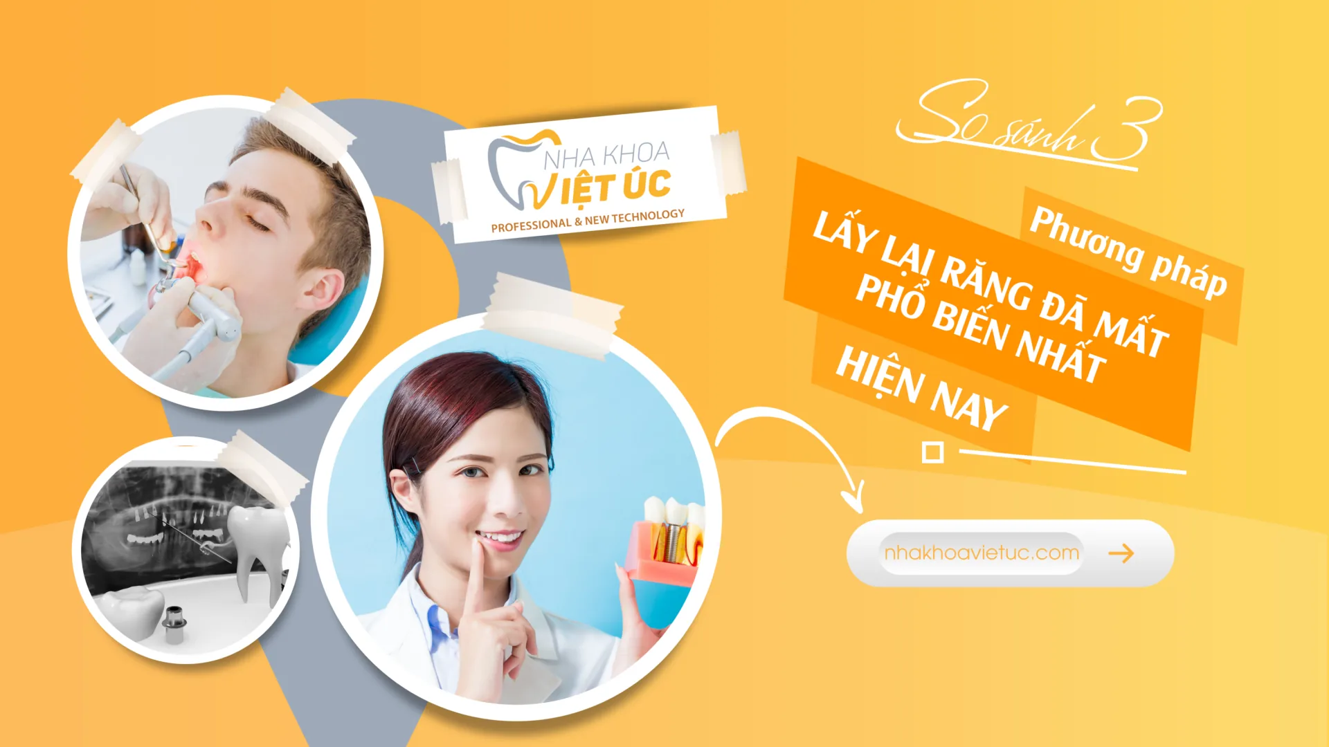 so sánh 3 phương pháp lấy lại răng đã mất phổ biến nhất hiện nay