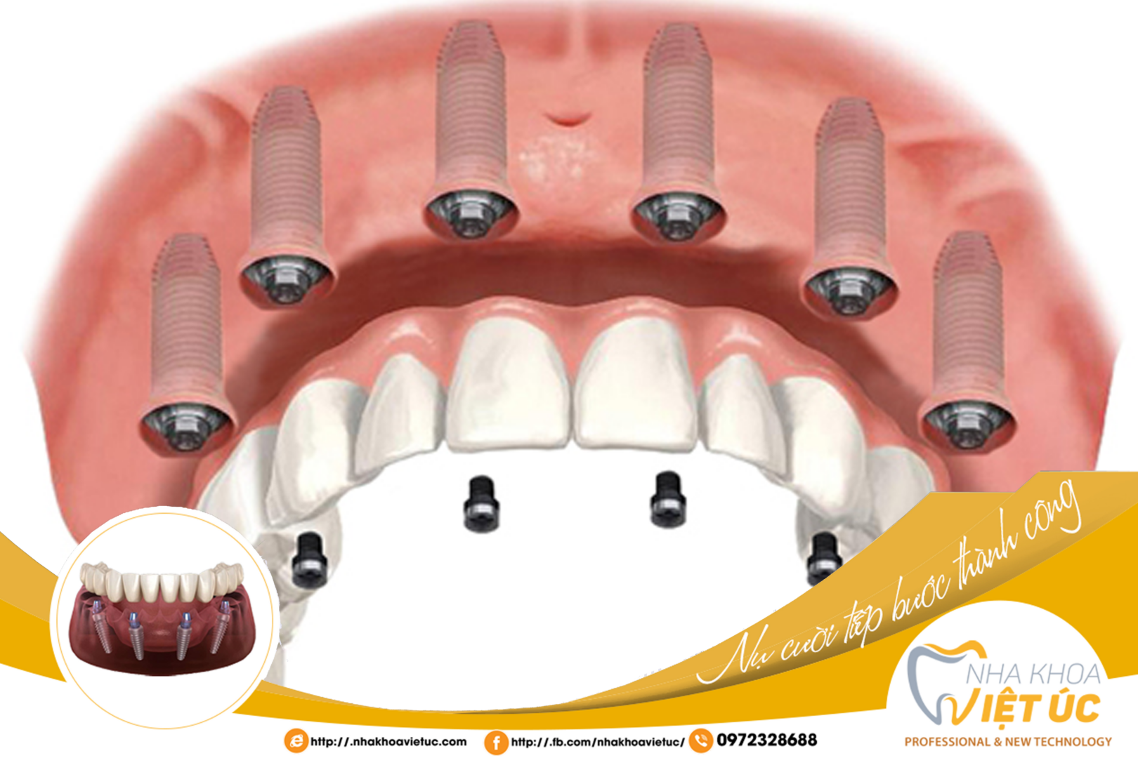 Trồng răng Implant toàn hàm All-on-6 thường sẽ được Bác sĩ chỉ định cho cô chú/anh chị tùy theo tình trạng xương hàm và vùng xương hàm