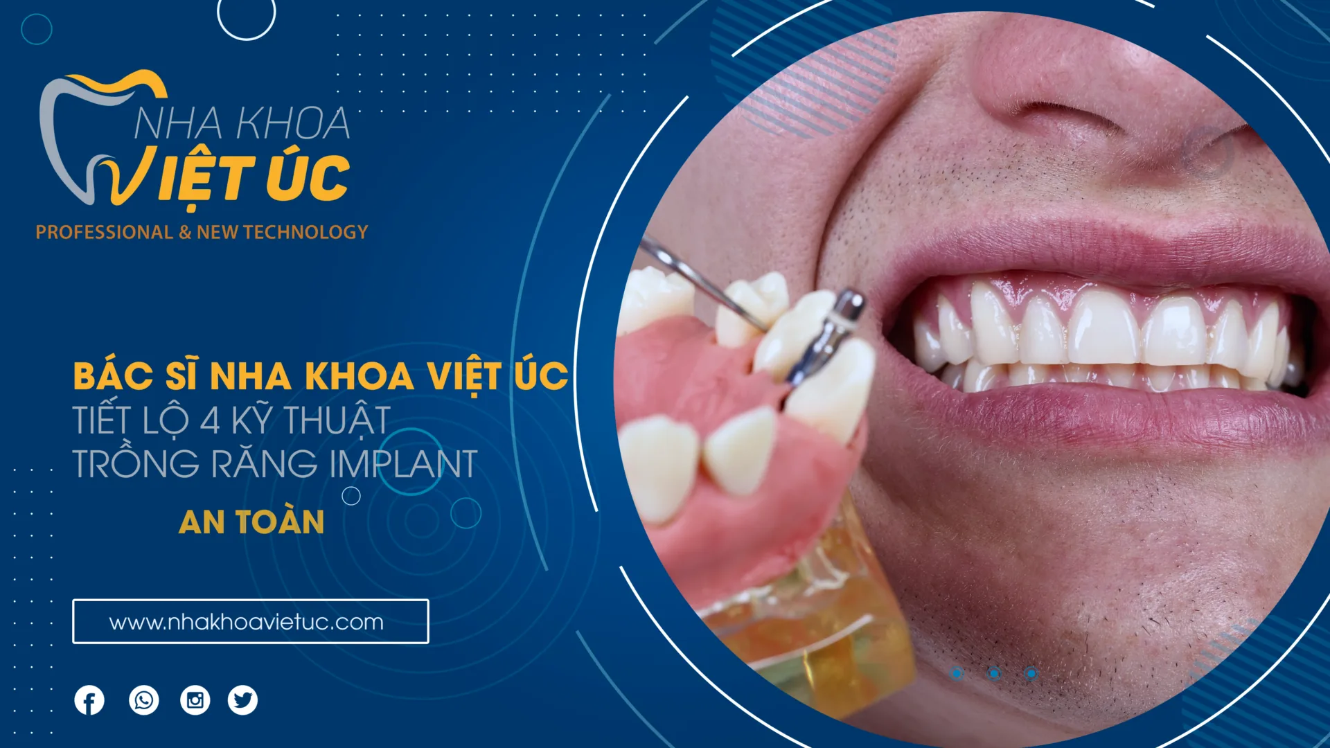 BÁC SĨ NHA KHOA VỆT ÚC TIẾT LỘ 4 KỸ THUẬT TRỒNG RĂNG IMPLANT AN TOÀN