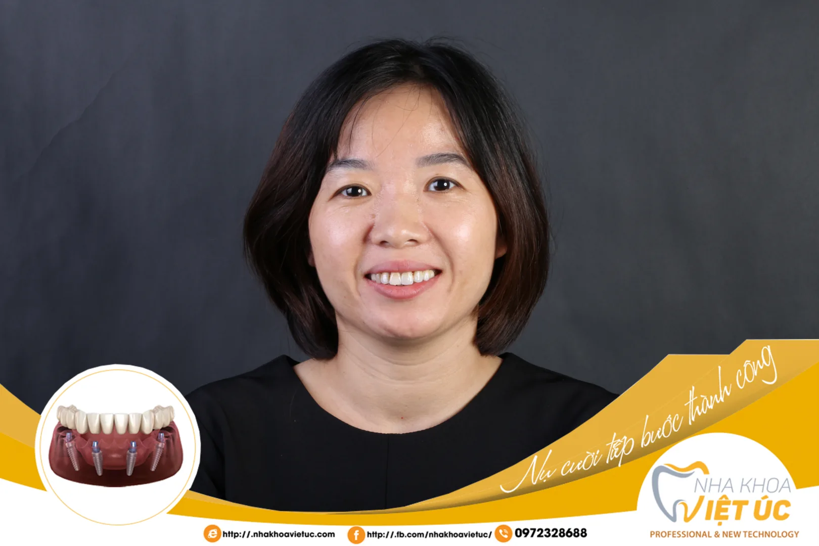 IMPLANT RĂNG CỬA - NGUYỄN NGỌC LUYẾN 38 TUỔI