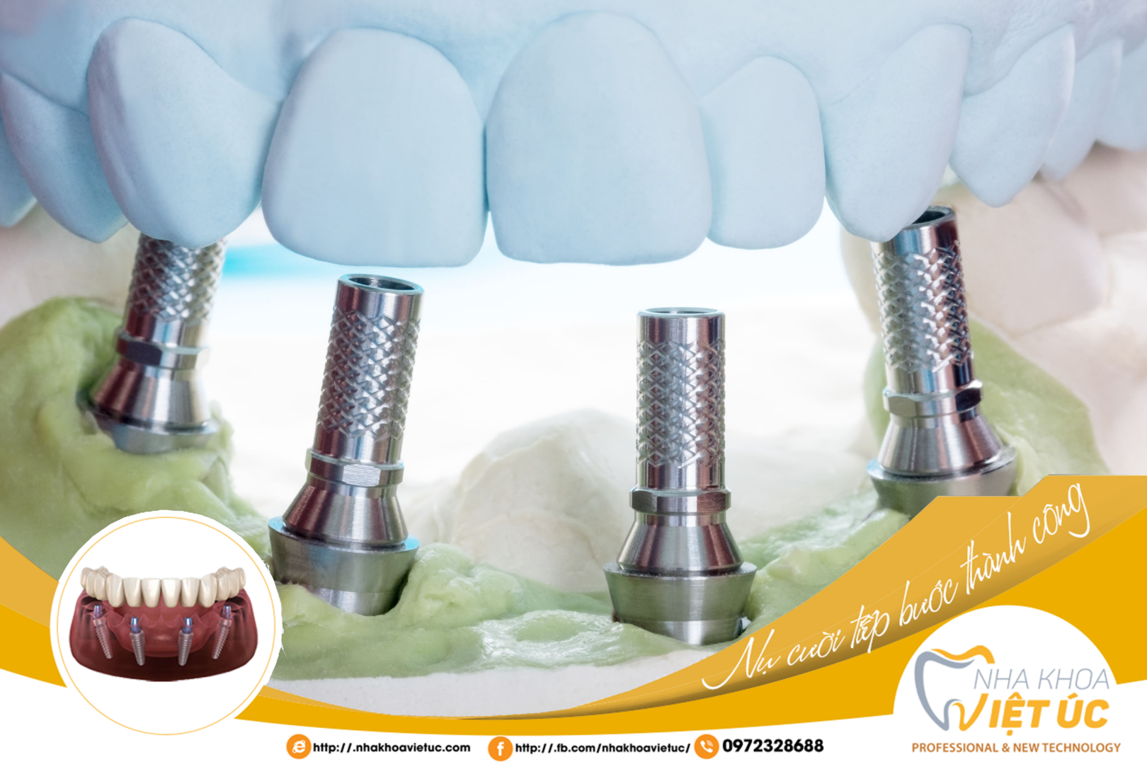 Trồng răng Implant toàn hàm All-on-4 giúp mọi người lấy lại răng đã mất chỉ với 4 trụ titanium đặt vào xương hàm