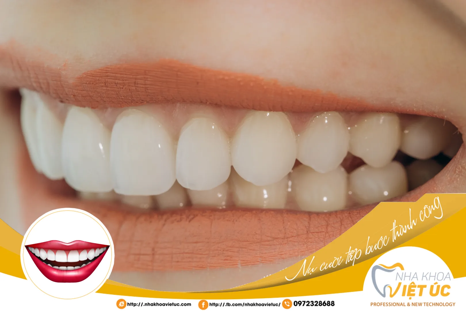 Khách hàng làm Veneer tại Nha khoa Việt Úc