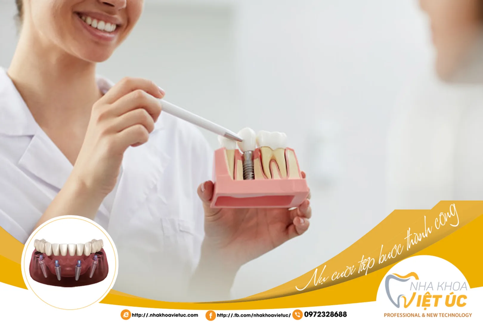 Trồng răng Implant với kỹ thuật cấy ghép Implant tức thì tại Nha khoa Việt Úc