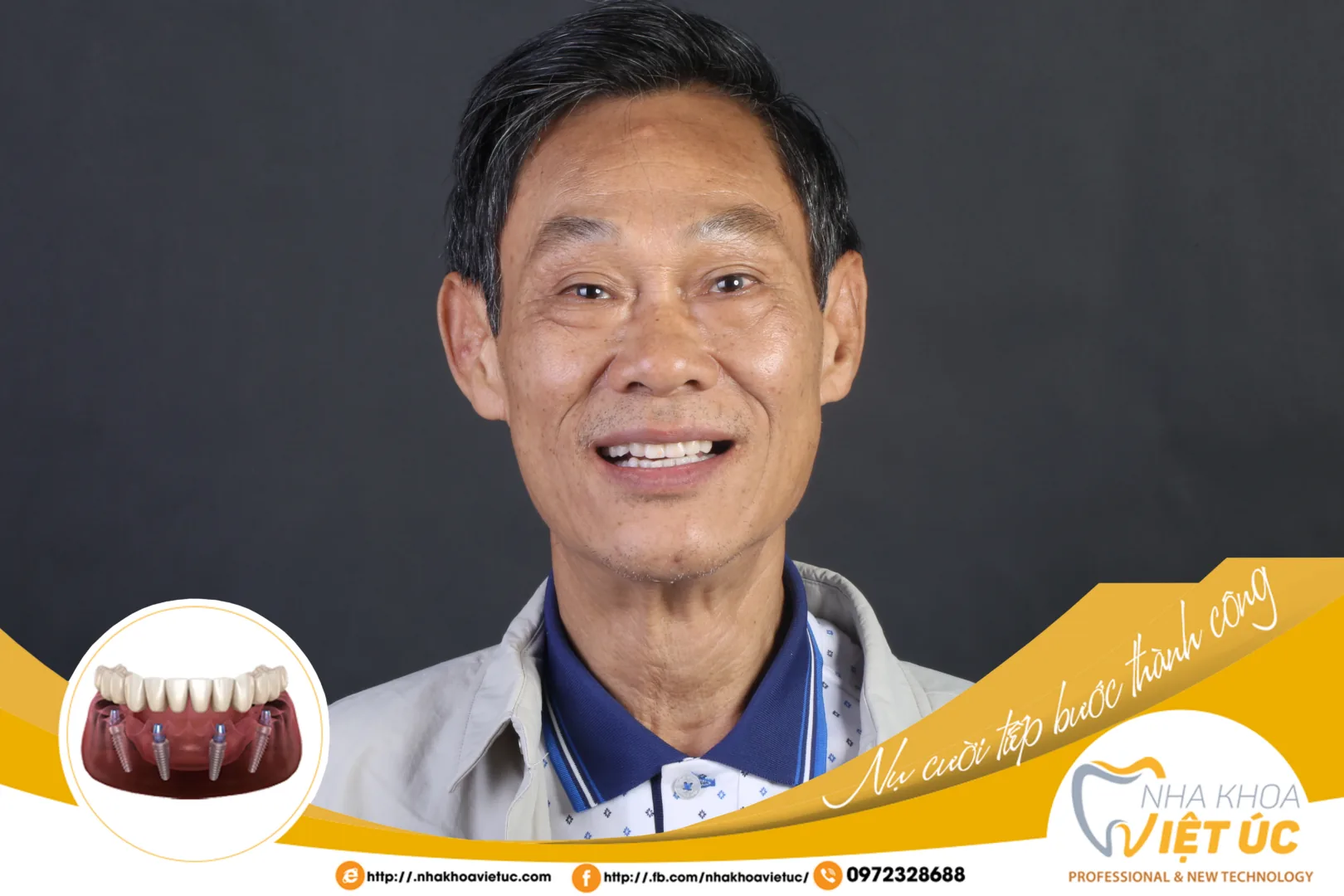 SAU KHI TRỒNG RĂNG BAO LÂU THÌ ĐƯỢC ĐI MÁY BAY