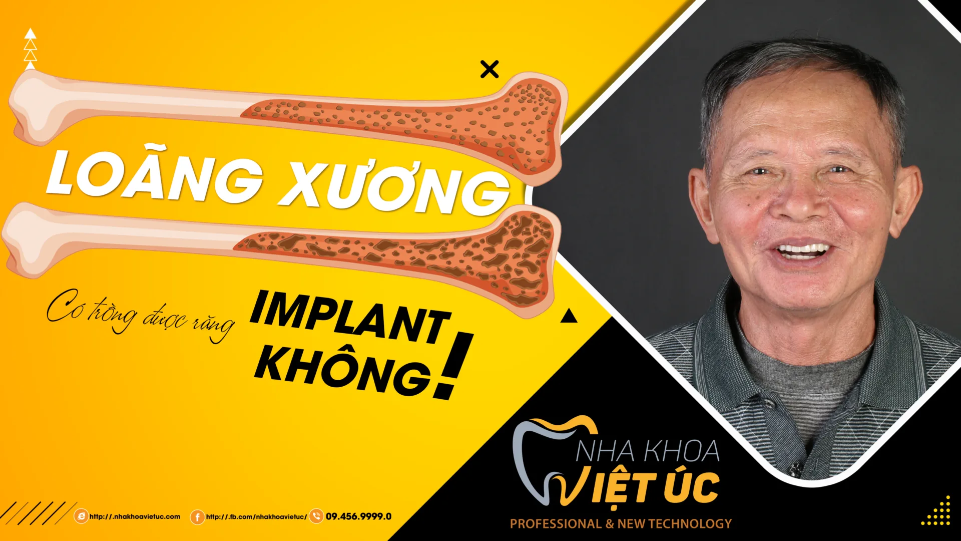 loãng xương có trồng được răng implant