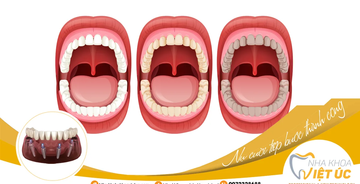 LÀM HƯ HẠI VÀ TỔN THƯƠNG RĂNG THẬT