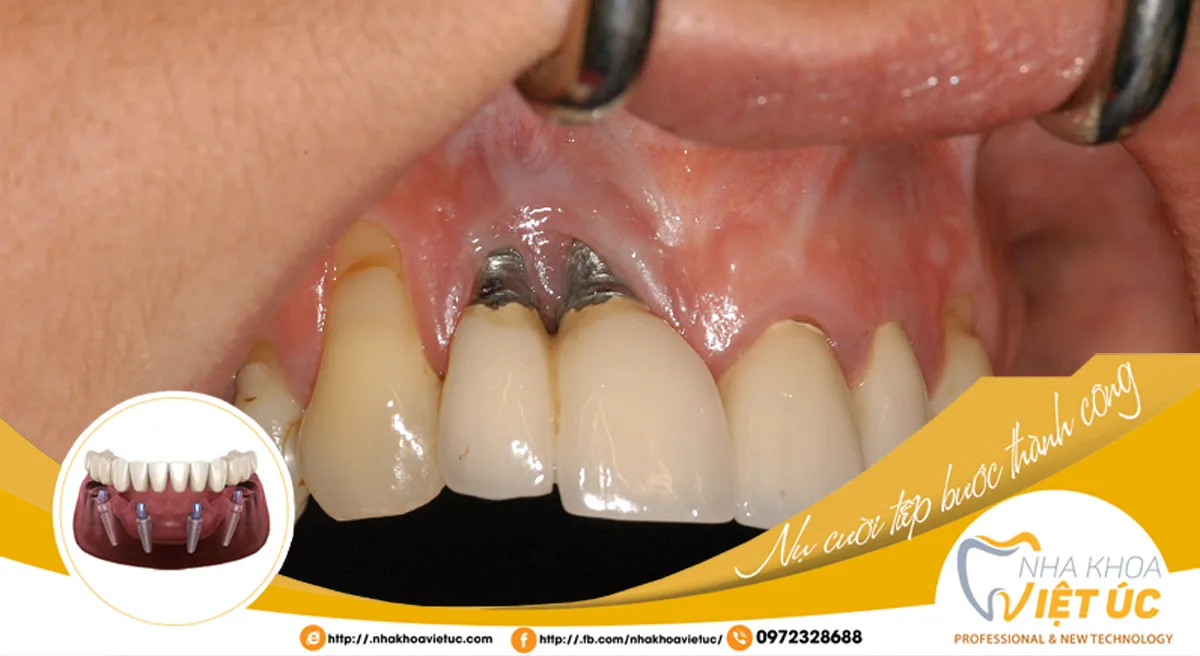 Rượu, bia ảnh hưởng đến kết quả trồng răng và khả năng ăn nhai gần như răng thật của răng Implant