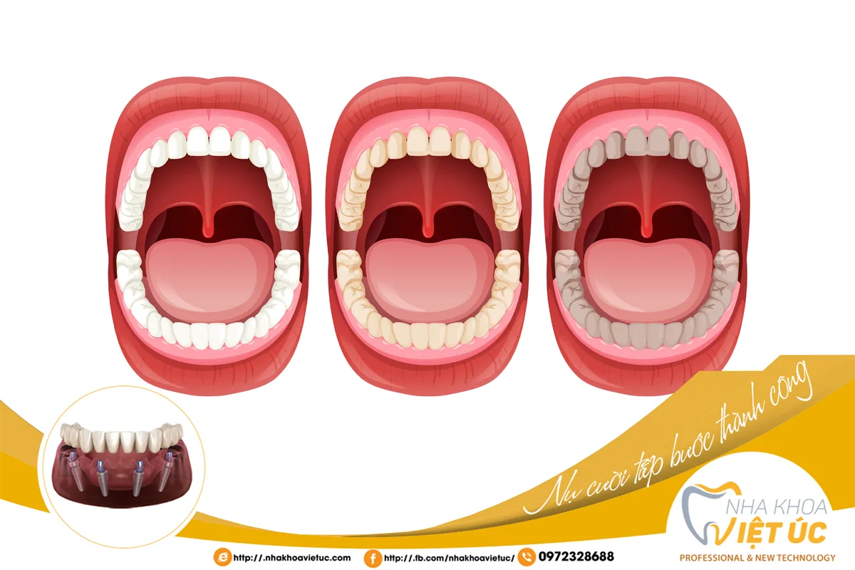 Sử dụng nhiều rượu, bia sẽ ảnh hưởng đến sức khỏe răng miệng nhất là men răng