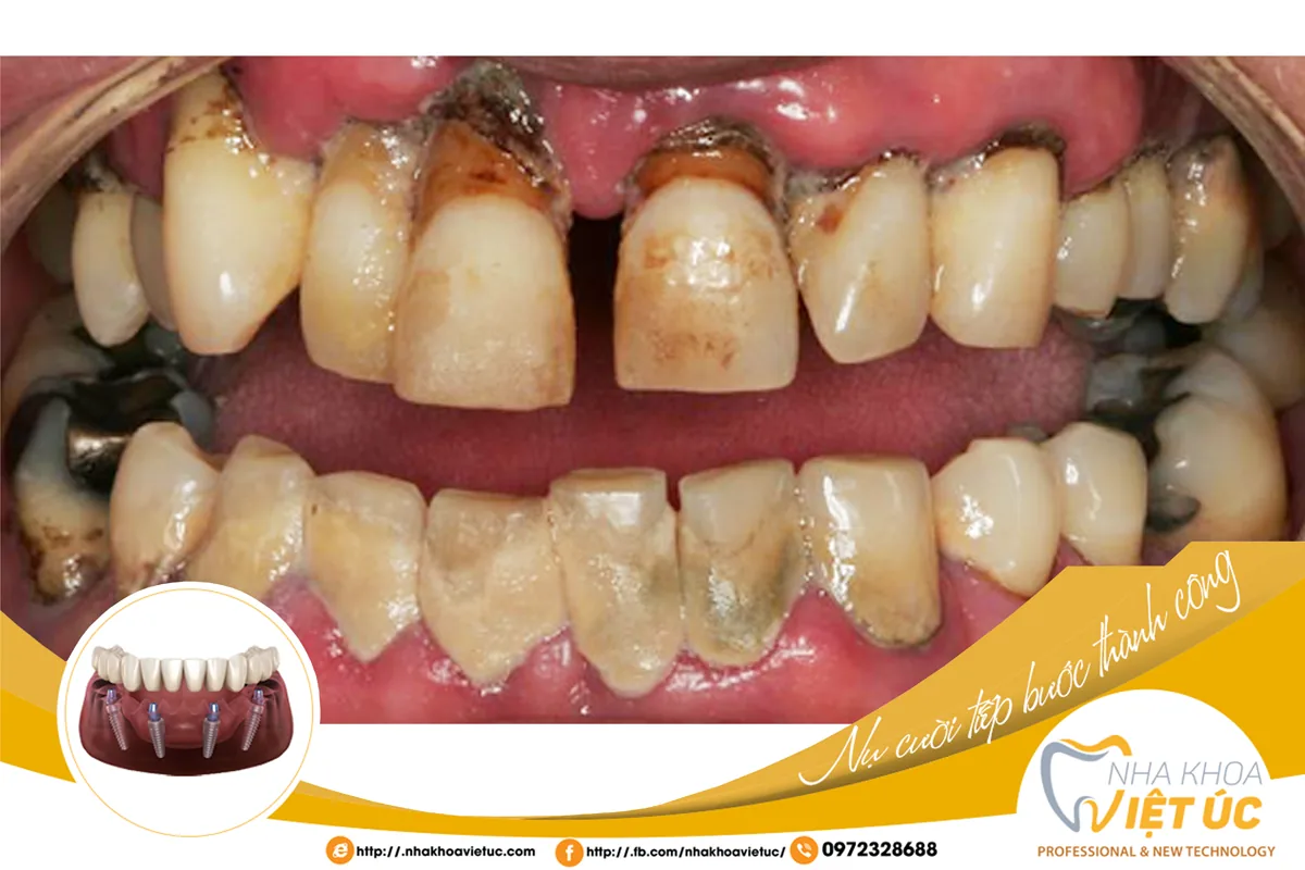 Rượu, bia ảnh hưởng đến kết quả trồng răng Implant và khả năng ăn nhai gần như răng thật