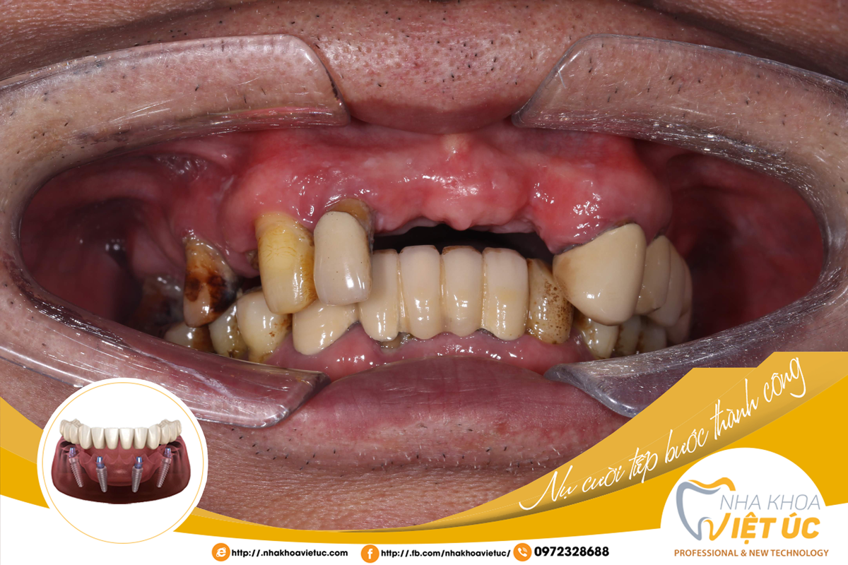 Người mất răng có thể lựa chọn cấy ghép Implant tại các bệnh viện và nha khoa uy tín