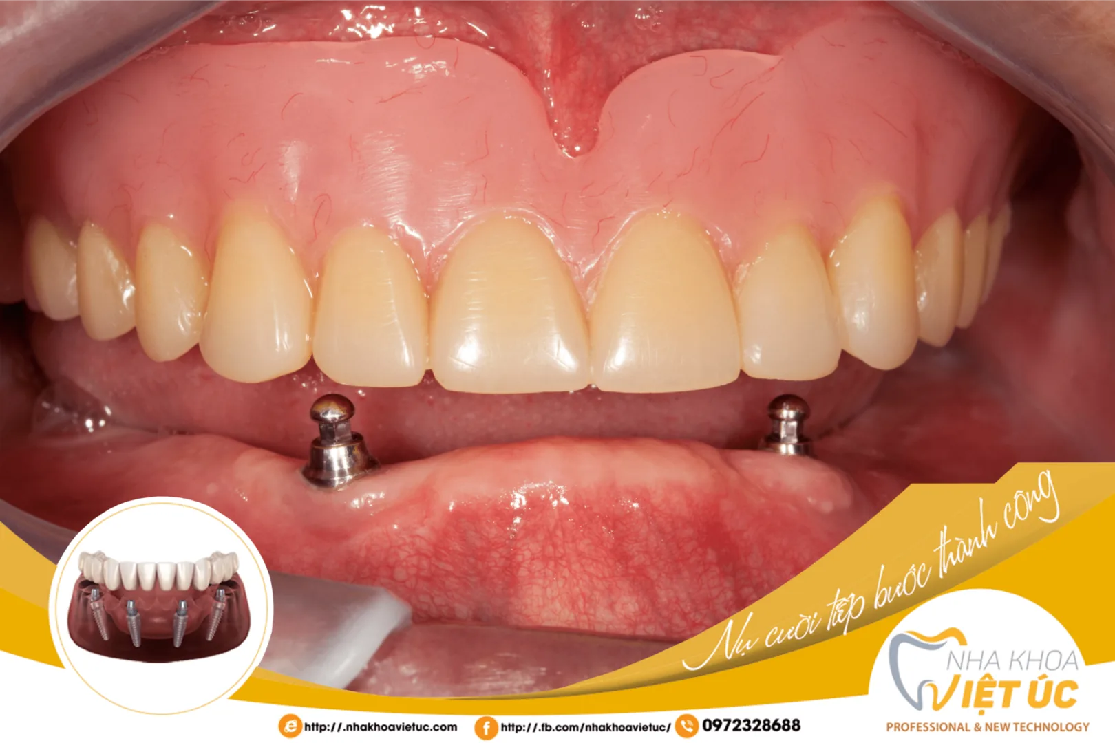 trồng răng giả cố định có đau không (1)