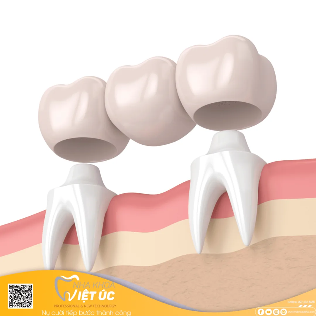 2 răng thật kế cận bị mài để làm trụ răng, lâu ngày sẽ dẫn đến tình trạng sâu răng, mất luôn răng thật