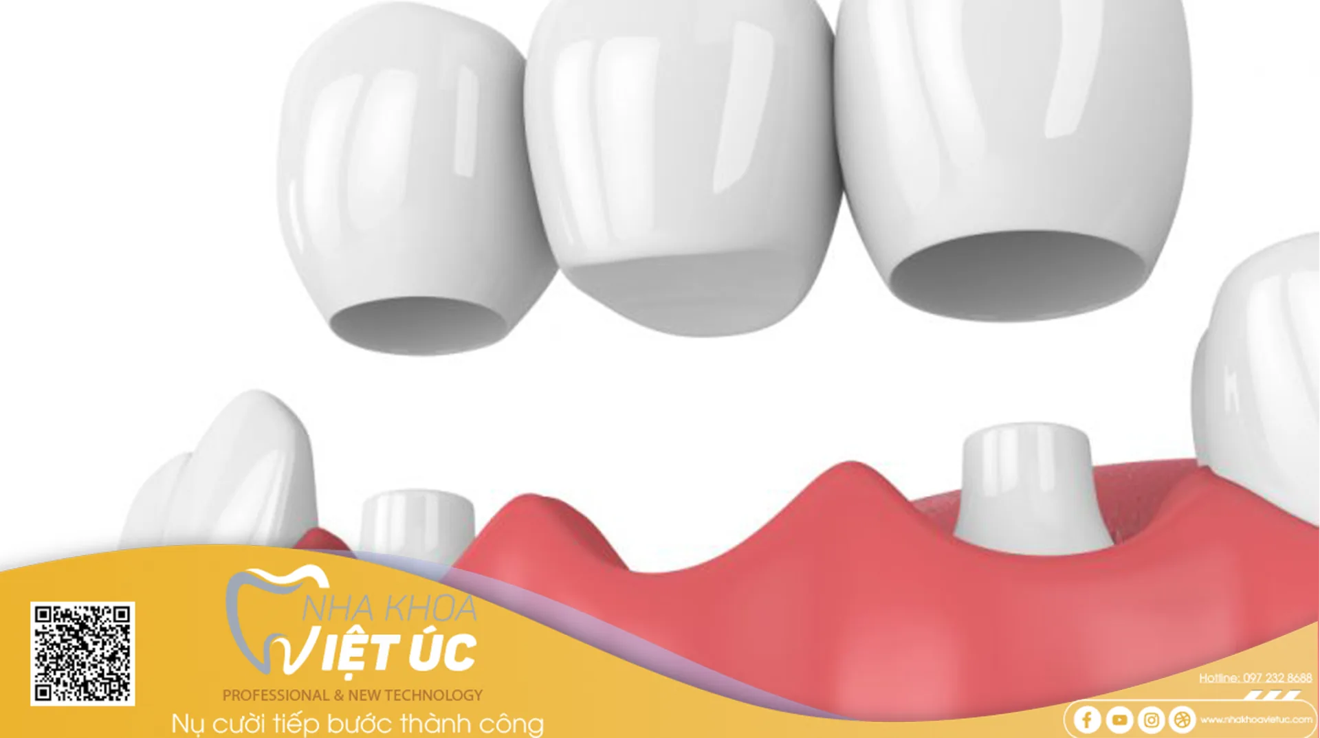 phương pháp này Bác sĩ sẽ phải thực hiện mài men răng, một khi men răng mất đi sẽ không thể phục hồi lại