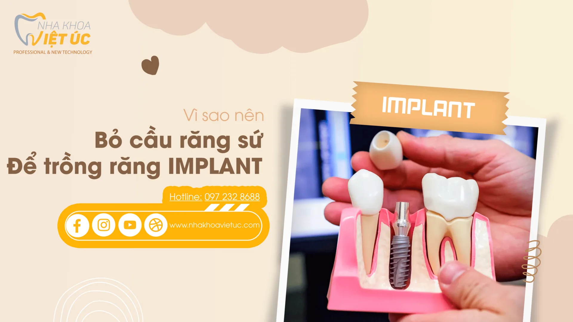 Vì sao nên bỏ cầu răng sứ để trồng răng implant