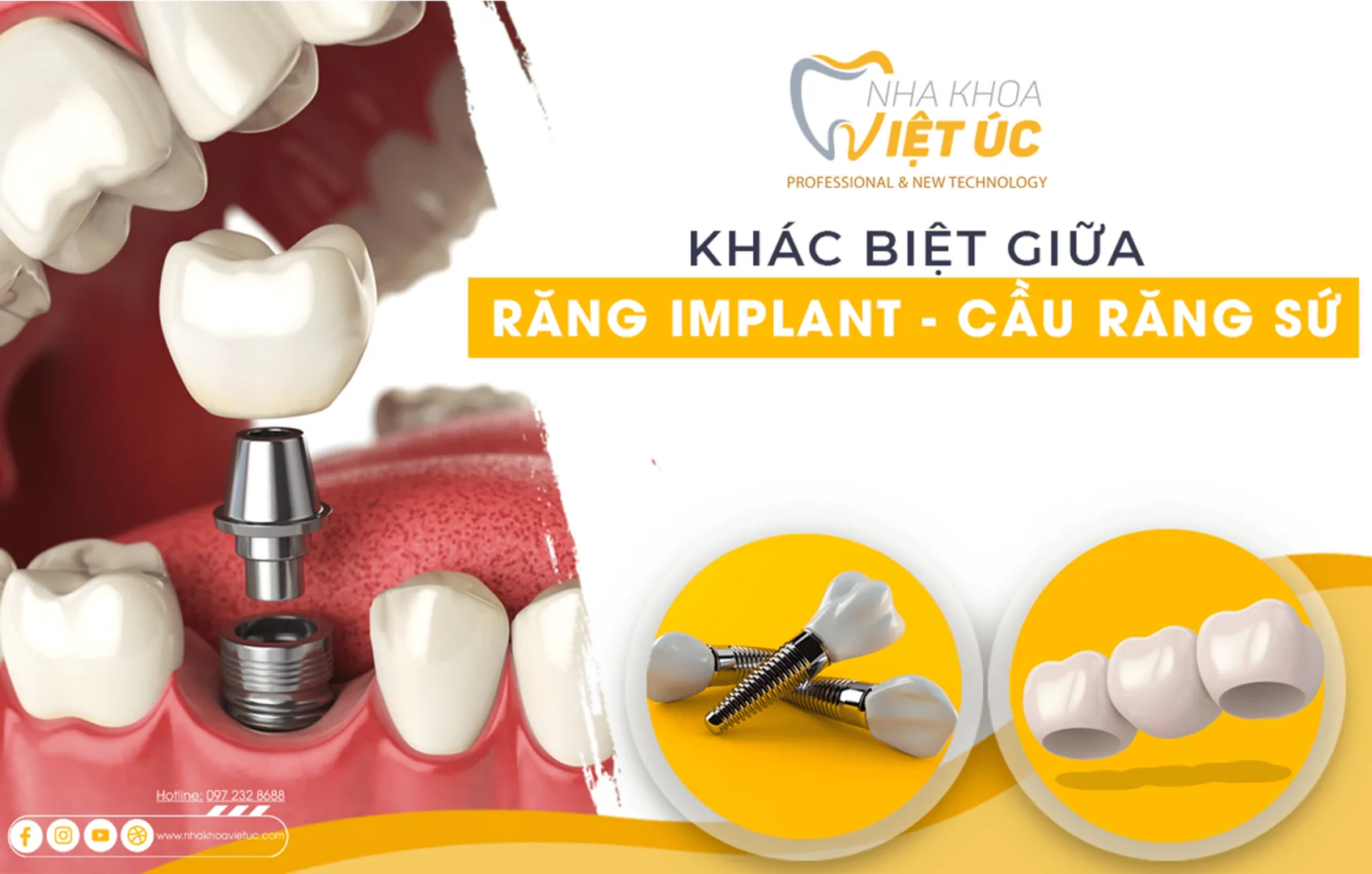 khác biệt giữa trồng răng implant và cầu răng sứ
