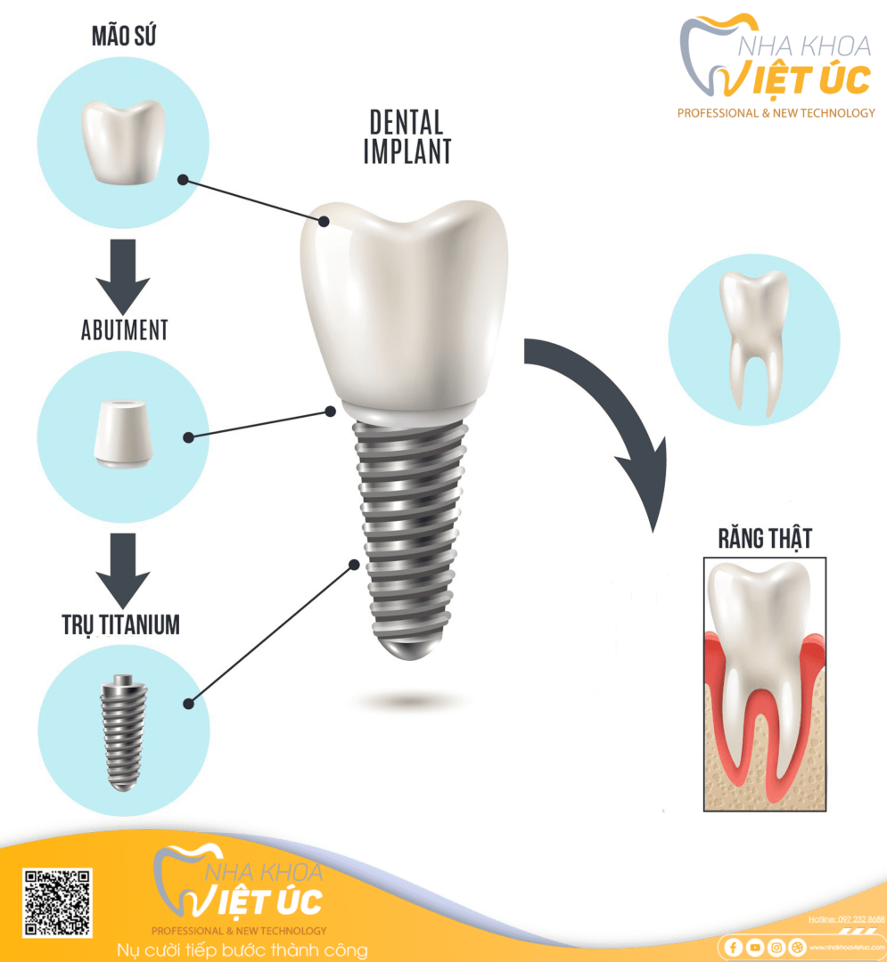 Răng Implant có cấu tạo gần như răng thật với 3 phần chính: Trụ Implant, khớp nối abutment và mão răng sứ.