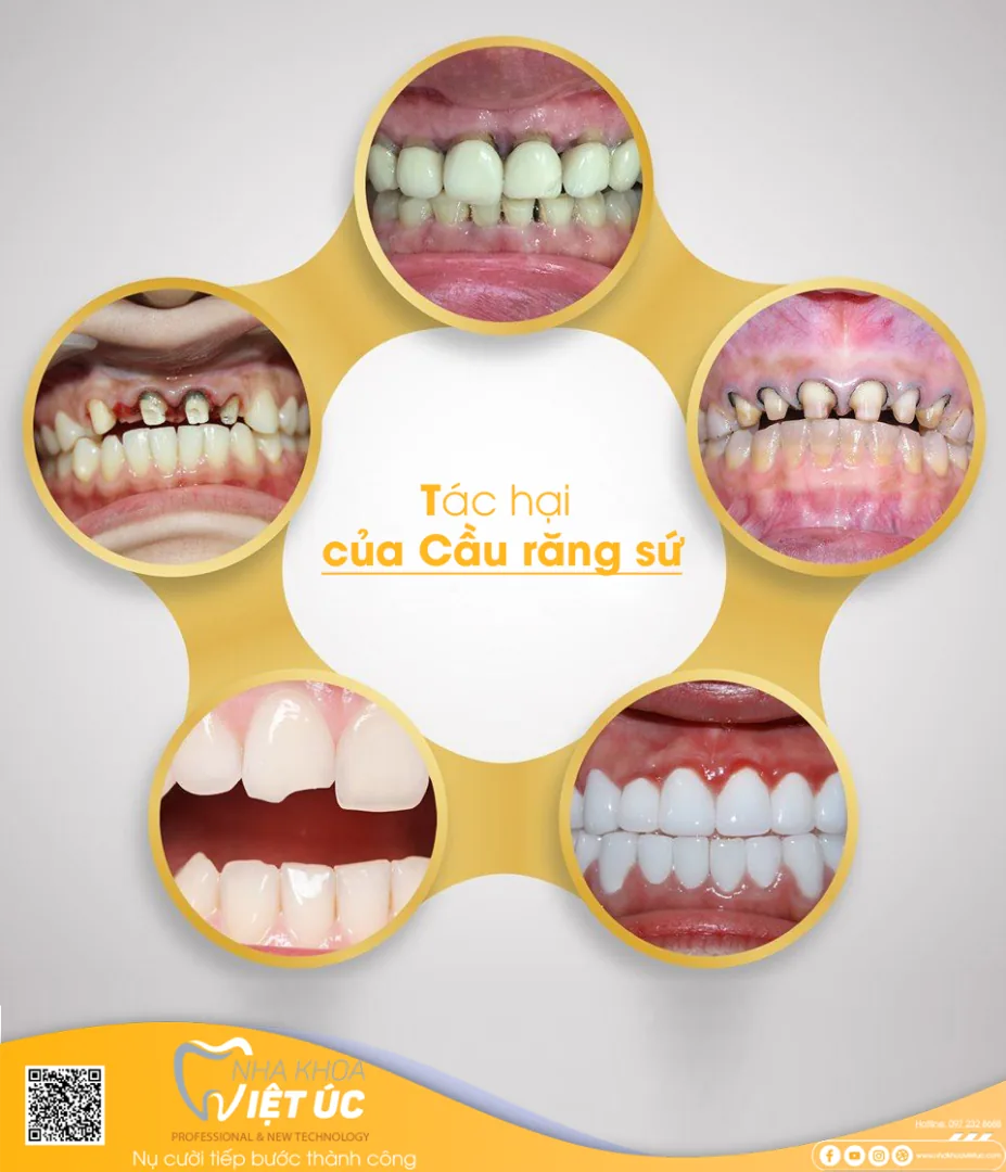 Sau thời gian dài dùng cầu răng sứ cô chú/anh chị sẽ gặp phải tình trạng tiêu xương hàm, gương mặt biến dạng, móm.Sau thời gian dài dùng cầu răng sứ cô chú/anh chị sẽ gặp phải tình trạng tiêu xương hàm, gương mặt biến dạng, móm.
