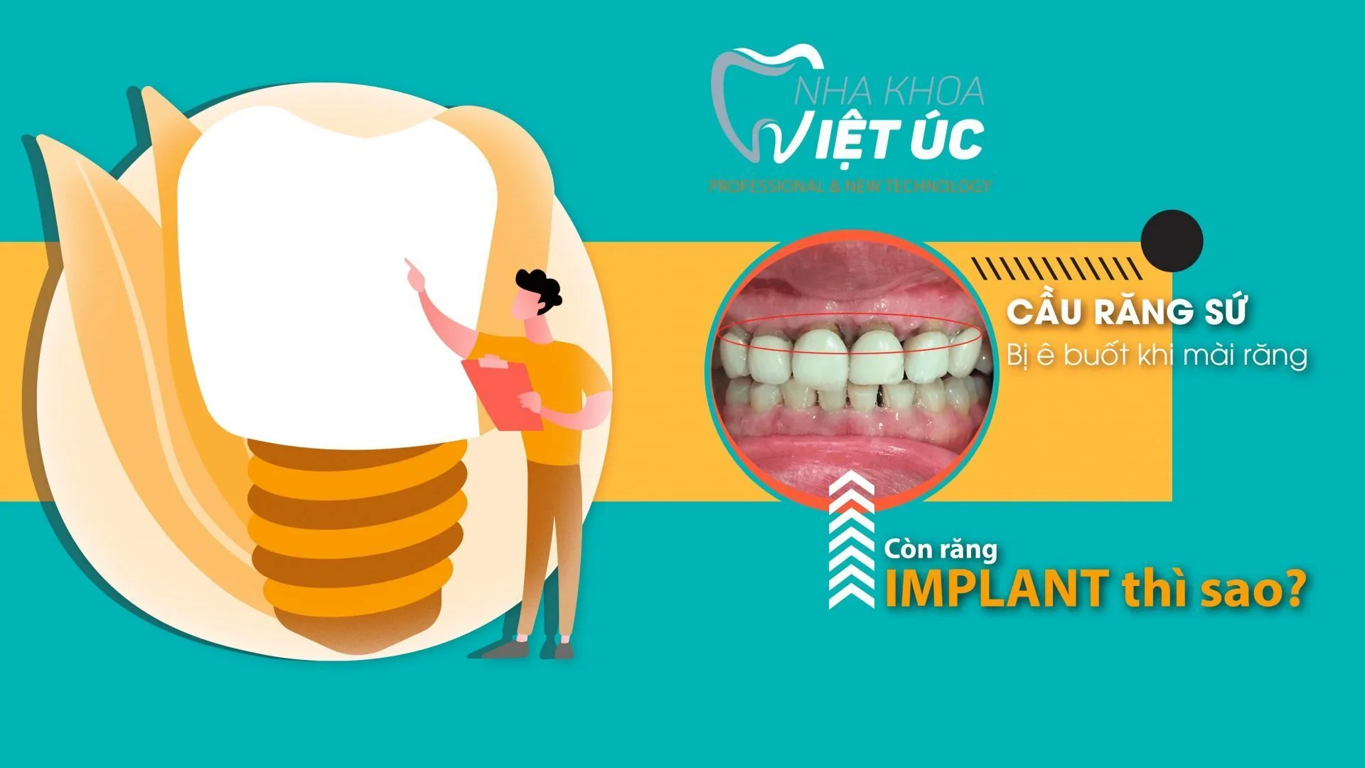 Cầu răng sứ bị ê buốt khi mài răng còn răng implant thì sao
