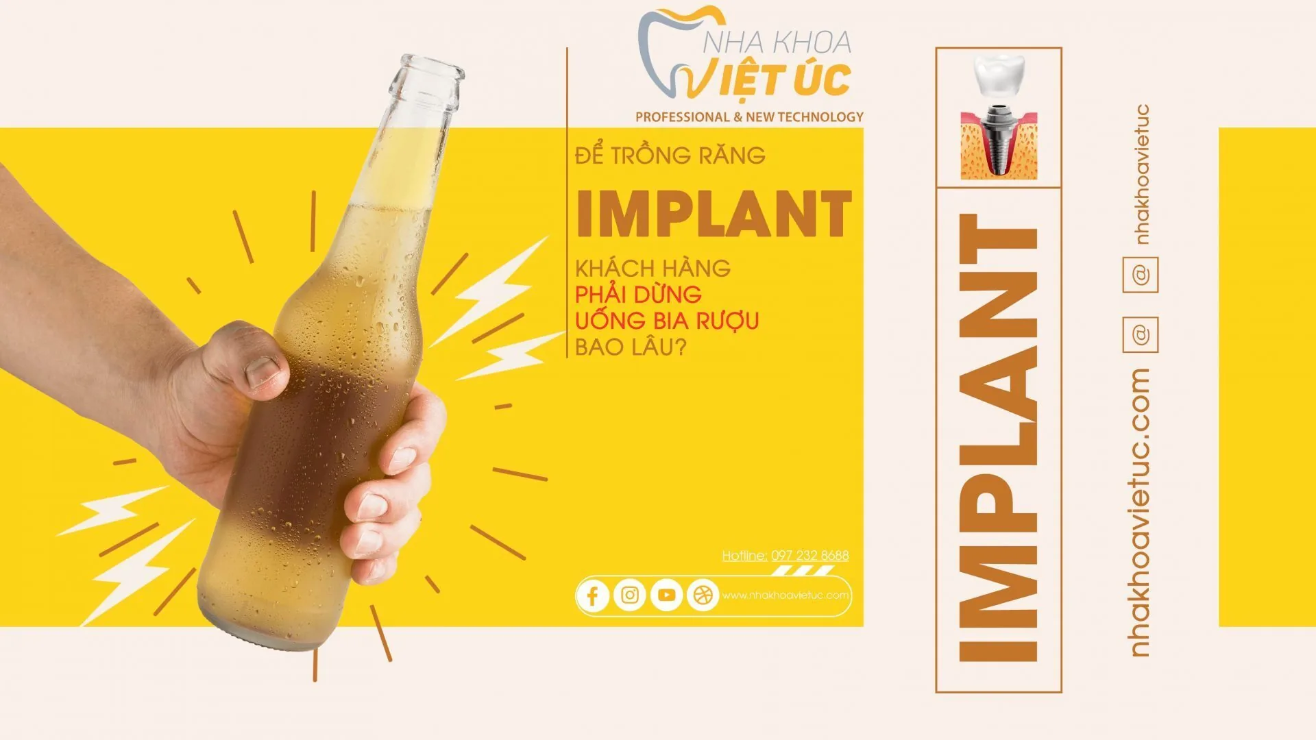 phải dừng uống rượu bia trong bao lâu để trồng được răng implant