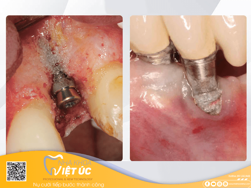 Viêm nhiễm vùng cấy ghép implant là một trong những biến chứng khi trồng răng implant