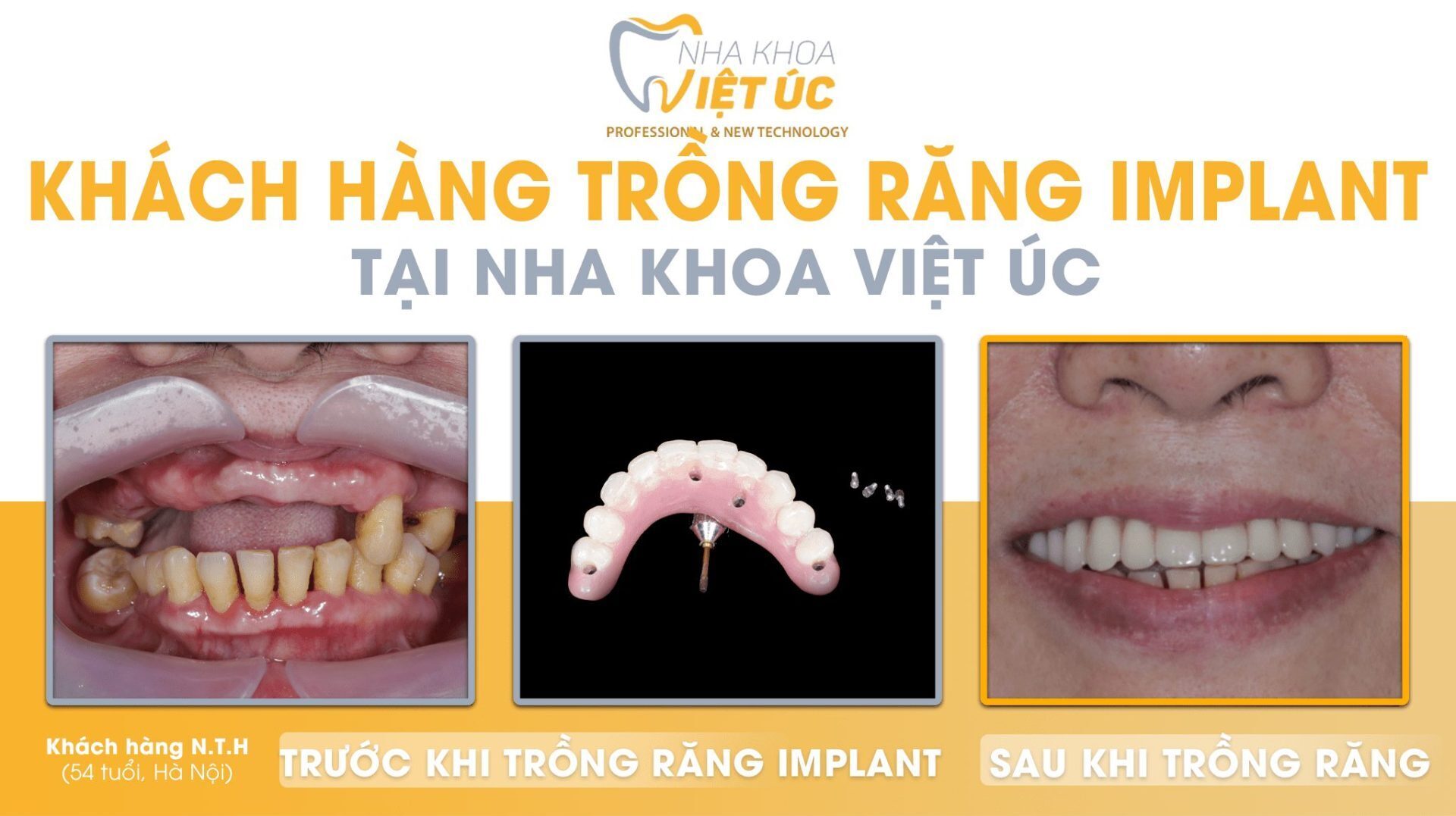 Khách hàng Nha khoa Việt Úc mất răng cửa lâu năm không phục hình răng sẽ dẫn đến tình trạng tụt nướu, tiêu xương hàm… 