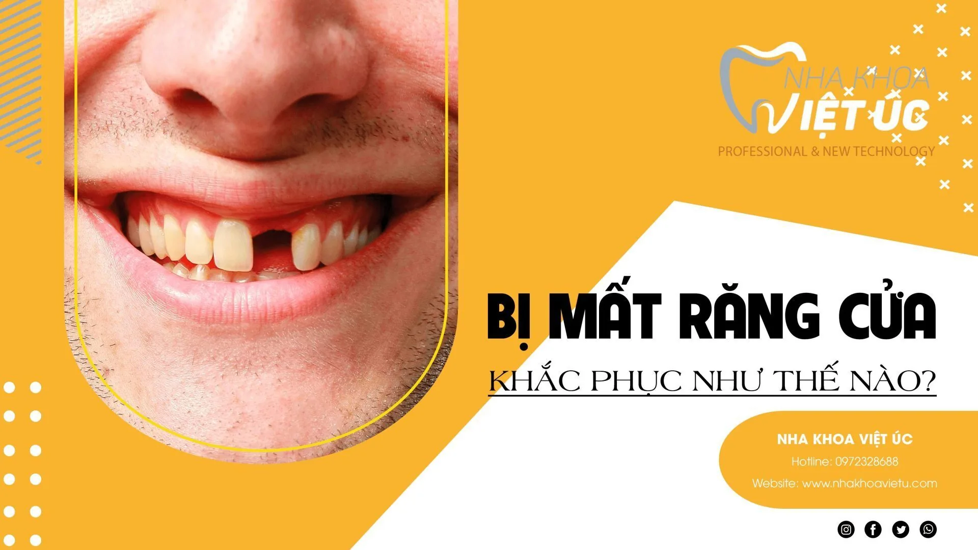 Không chỉ đảm nhiệm chức năng ăn nhai, răng cửa còn mang lại tính thẩm mỹ cho gương mặt