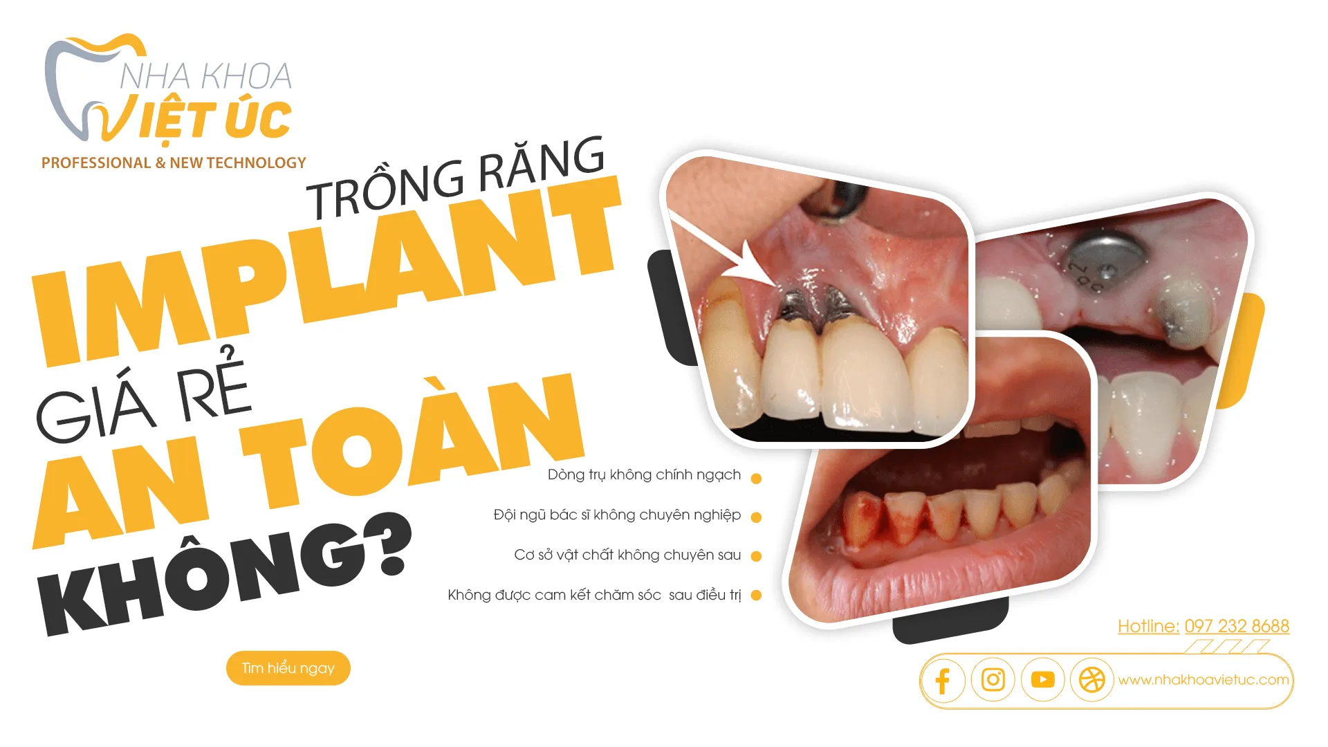 trồng răng im plant giá rẻ an toàn không nha khoa việt úc