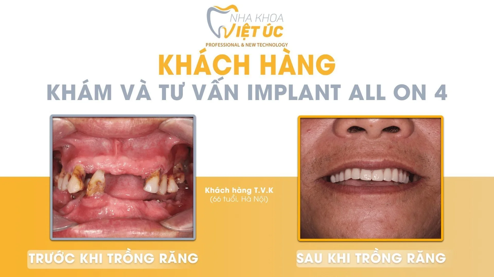 trường hợp mất răng có thể phục hồi bằng kỹ thuật All - on 4
