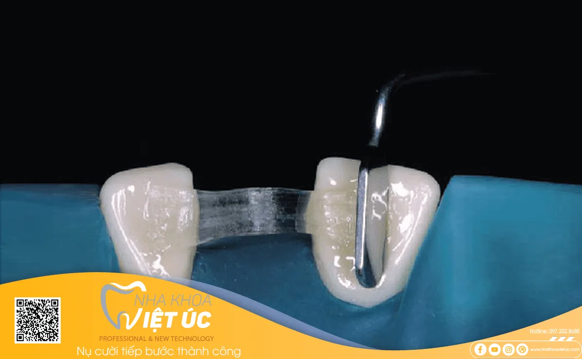 Cầu răng sứ Composite