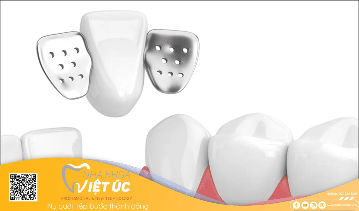 Cầu răng sứ cánh dán