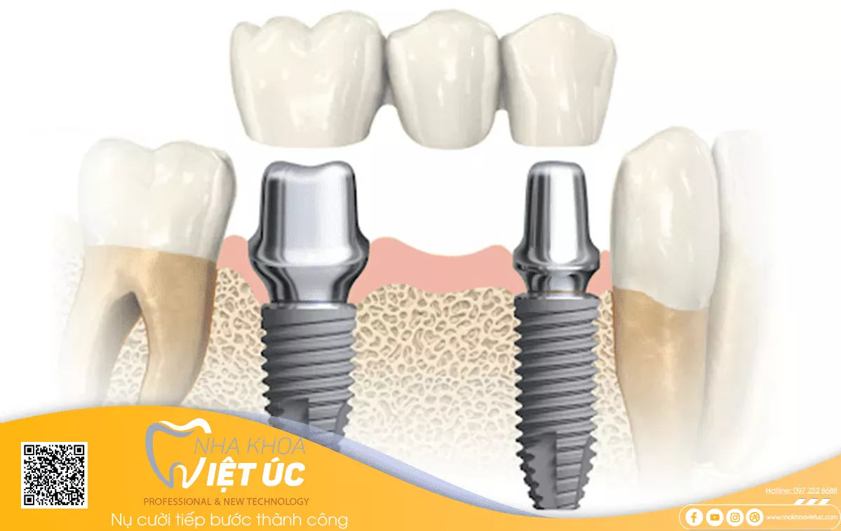 Cầu răng sứ được hỗ trợ Implant