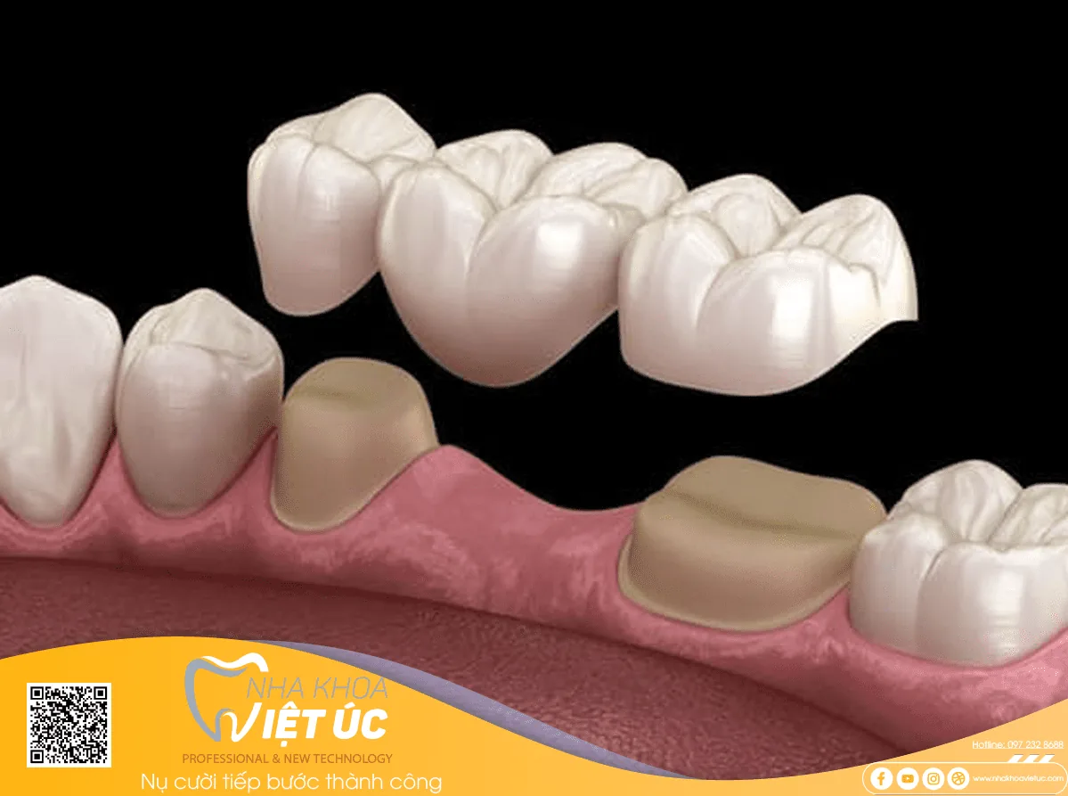 Cầu răng sứ nhảy