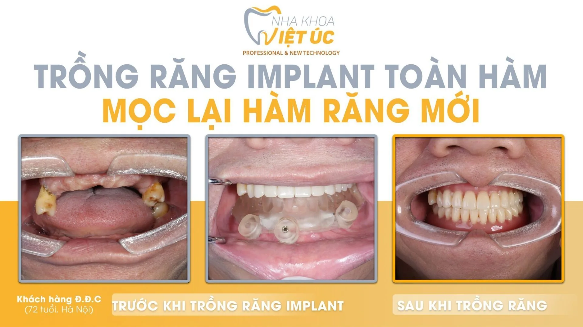 implant all on 4