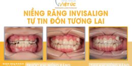 Niềng răng Invisalign – Tự tin đón tương lai