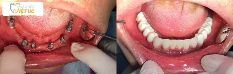 lam-rang-implant-co-hut-thuoc-la-duoc-khong-1 (1)
